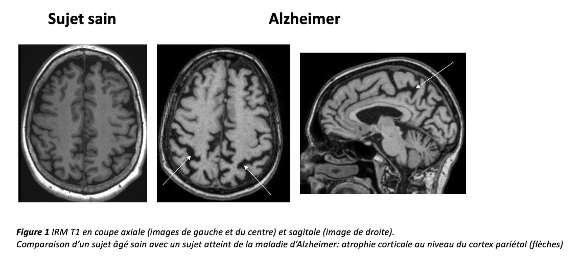 IRM d'un cerveau sain comparé à un cerveau de malade d'Alzheimer