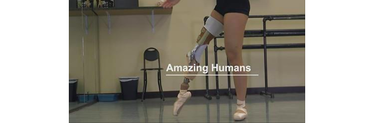 Amputée de la jambe, elle ne renonce pas à son rêve : la danse
