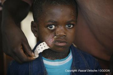 Mission Internationale au Burkina Faso pour sauver les enfants victimes du NOMA